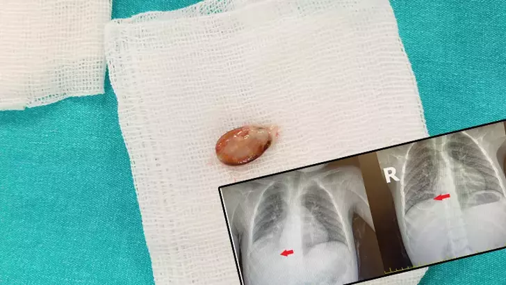 Nefes borusundaki cekirdekle